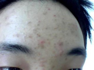 额头上长痘痘是什么原因